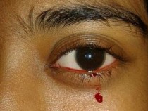 Мистерия: Здраво 11-годишно момиче изведнъж изплака кървави сълзи СНИМКА