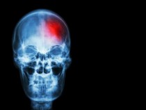 Доц. д-р Андриан Тонев посочи причината за 30% от инсултите