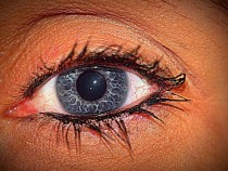 Първа помощ при конюнктивит