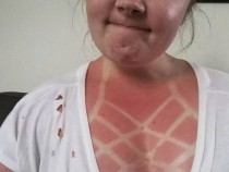 СНИМКИ с най-абсурдните слънчеви изгаряния на хора