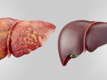 Нещата, които унищожават черния ни дроб, без да подозираме