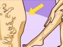 6 прости начина за предпазване от разширени вени