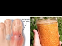 Никога няма да повярвате, но този домашен лек лекува от подагра