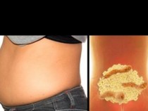 В червата ни има 9 кг отпадъци, част от които са мазнини. Само за 7 дни може да изхвърлите всичко