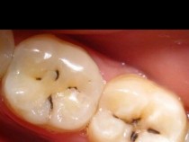 Начините, по които моментално ще разберете дали имате липса на калций, а това е много важно за здравето ви