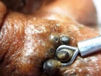 Мъчеше го сърбеж в носа, но това, което изтръгна, накара лекаря да оповръща цялото отделение! (ВИДЕО)