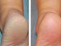 С тези две съставки ще изгладите петите си до съвършенство